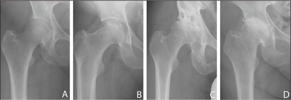 Estágios de desenvolvimento da artrose da articulação do quadril em uma radiografia