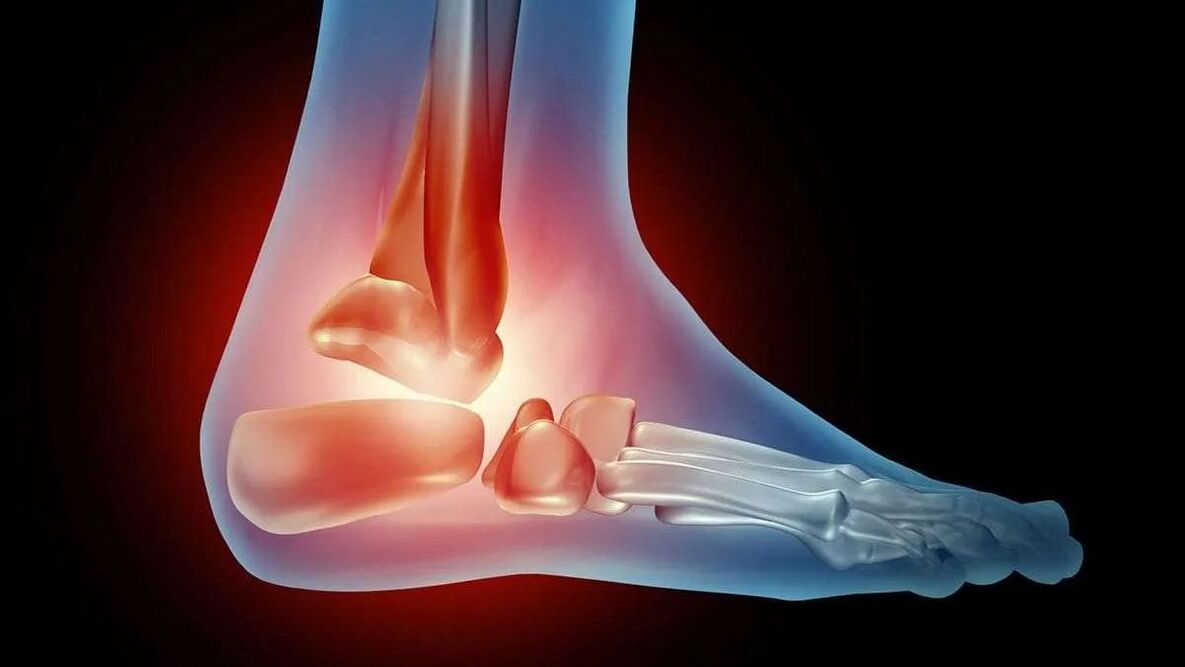 diagrama de artrose do tornozelo