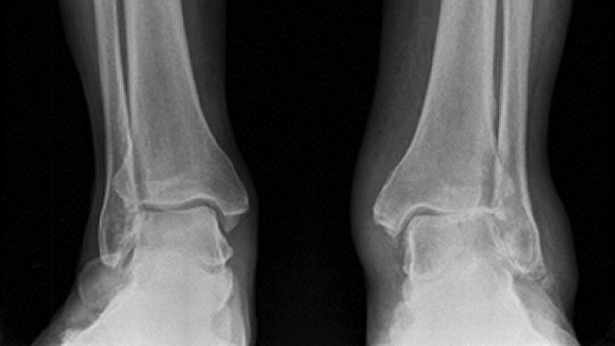 radiografia do tornozelo