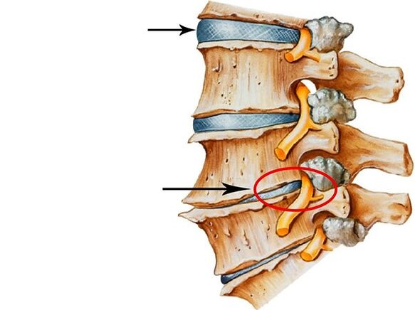 Distúrbios em discos intervertebrais