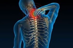 osteocondrose cervical leva à dor no pescoço