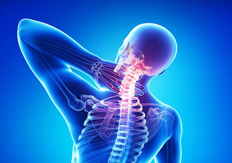 A osteocondrose espinhal é uma doença que afeta a cartilagem articular e as vértebras.
