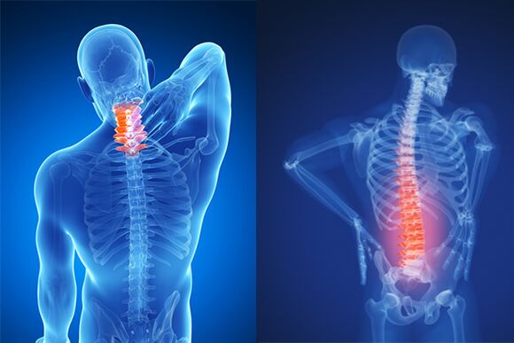Osteocondrose da coluna cervical e lombar