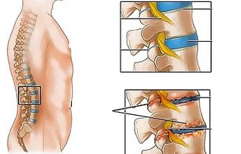 As causas da osteocondrose da lombar