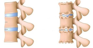 Como reconhecer a presença de osteocondrose da lombar