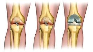 endoprótese para artrose da articulação do joelho